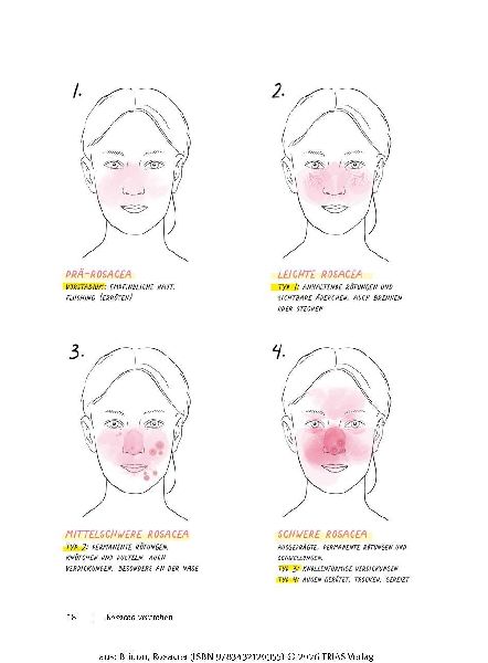 Rosacea