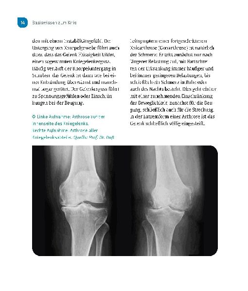 Schmerzfrei & beweglich mit dem neuen Kniegelenk