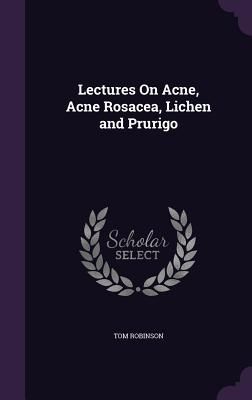 Lectures On Acne, Acne Rosacea, Lichen and Prurigo