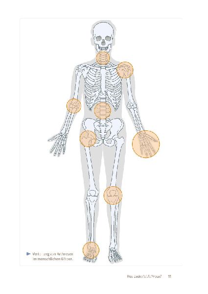 Expertenwissen: Arthrose