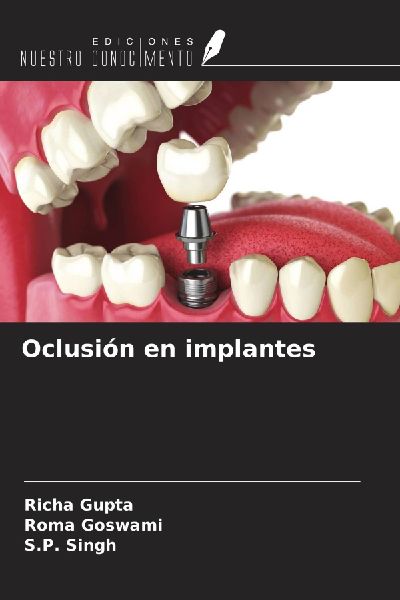 Oclusión en implantes