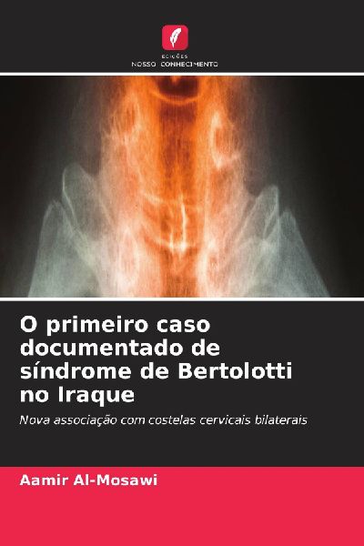 O primeiro caso documentado de síndrome de Bertolotti no Iraque