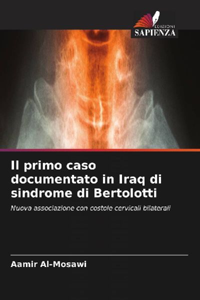 Il primo caso documentato in Iraq di sindrome di Bertolotti