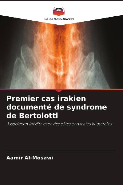 Premier cas irakien documenté de syndrome de Bertolotti