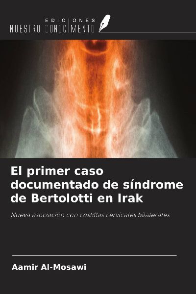El primer caso documentado de síndrome de Bertolotti en Irak